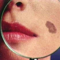 Ung thư da trầm trọng vì mỹ phẩm tắm trắng siêu tốc